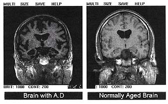 File:Alzheimers disease - MRI.jpg