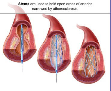 File:Coronary stent.jpg