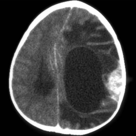 File:Brain tumor-CT.png