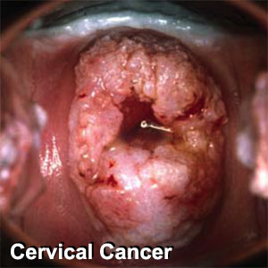 Cervical cancer.jpg