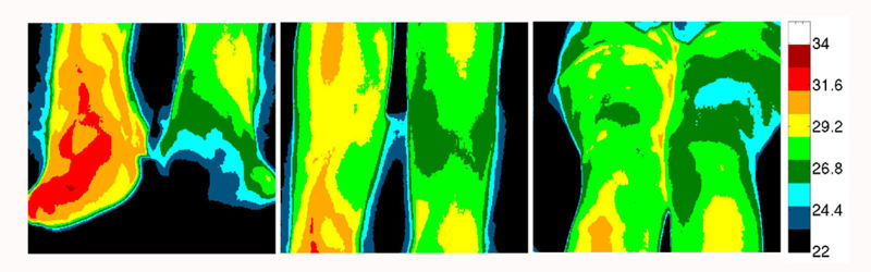 File:Extremities in RSD thermographic image.jpg