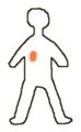 5 A diagram showing a person with a tumor (in blue) which is being treated with an open source after the radioactivity has localised in one part of the body(the radioactivity shown in orange)
