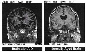 Alzheimers disease - MRI.jpg
