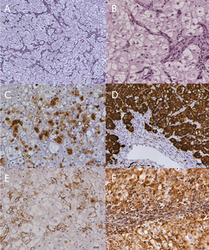 Chordoma immunohistochemistry.png