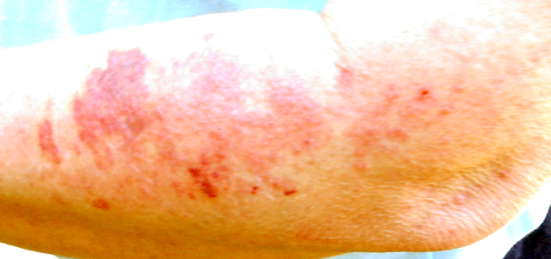 File:Atopic dermatits color corrected.png