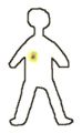 3 A diagram showing a person with a tumor (in blue) which is being treated with brachytherapy (the source shown in red and the gamma rays are shown in yellow)