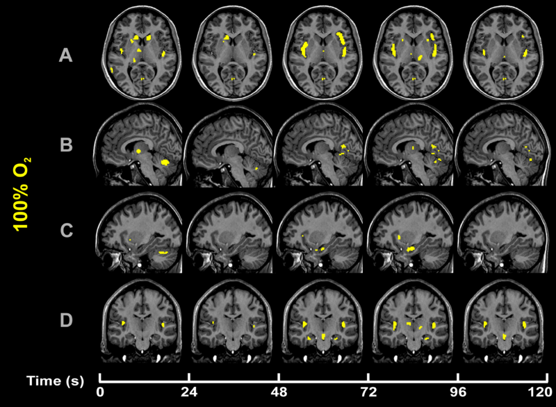 File:CO2-O2-fMRI-hyperoxia-over-time.png