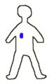 1 A diagram showing a person with a tumor (in blue)